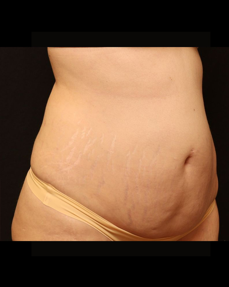 Mini Tummy Tuck Before and After 01